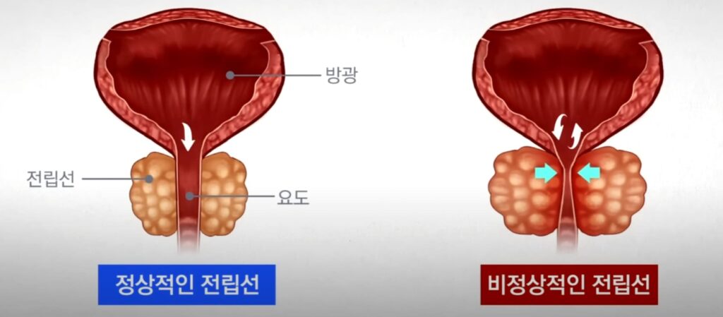 정상적인 전립선과 전립선비대증 차이